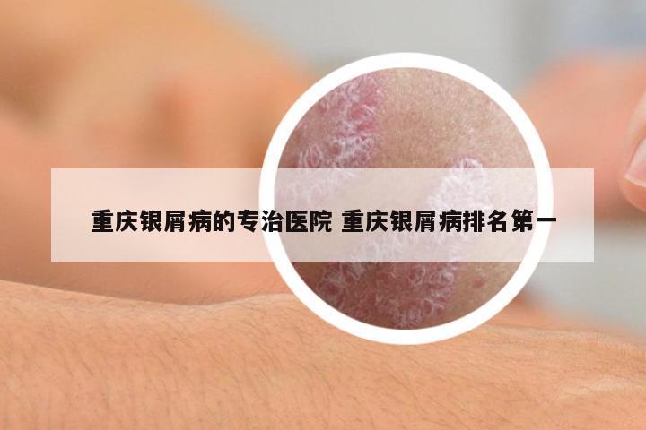 重慶銀屑病的專(zhuān)治醫(yī)院 重慶銀屑病排名第一