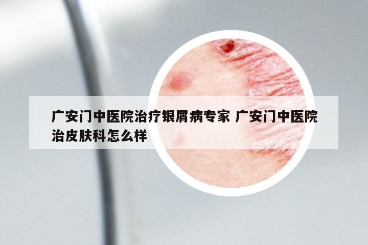 廣安門中醫(yī)院治療銀屑病專家 廣安門中醫(yī)院治皮膚科怎么樣