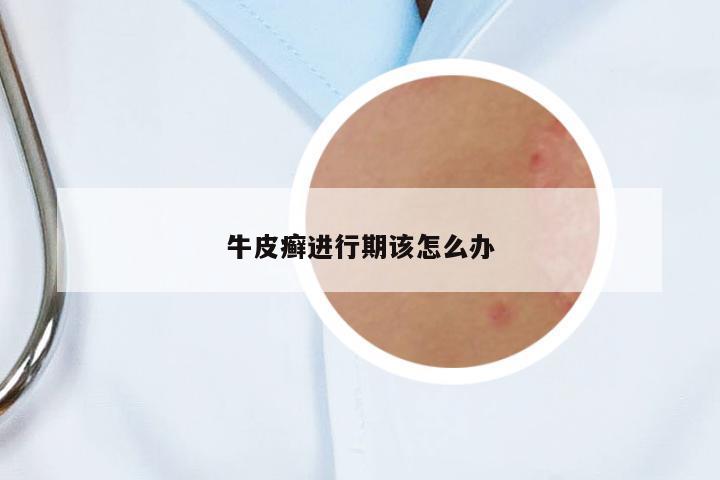 牛皮癬進(jìn)行期該怎么辦