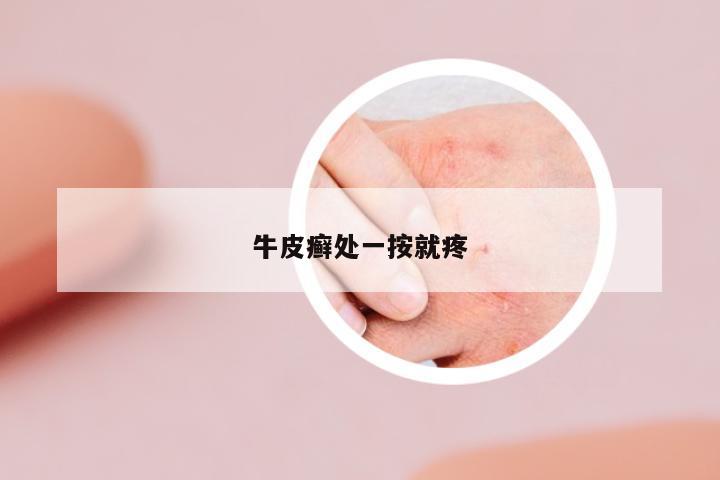 牛皮癬處一按就疼