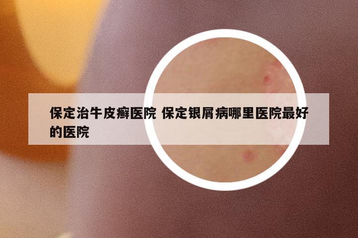保定治牛皮癬醫(yī)院 保定銀屑病哪里醫(yī)院最好的醫(yī)院