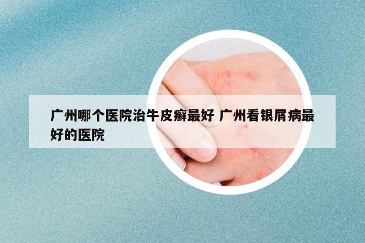廣州哪個醫(yī)院治牛皮癬最好 廣州看銀屑病最好的醫(yī)院