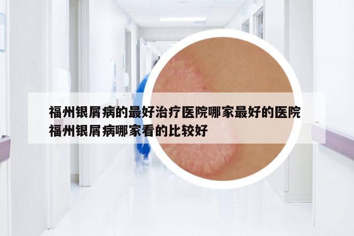 福州銀屑病的最好治療醫(yī)院哪家最好的醫(yī)院 福州銀屑病哪家看的比較好