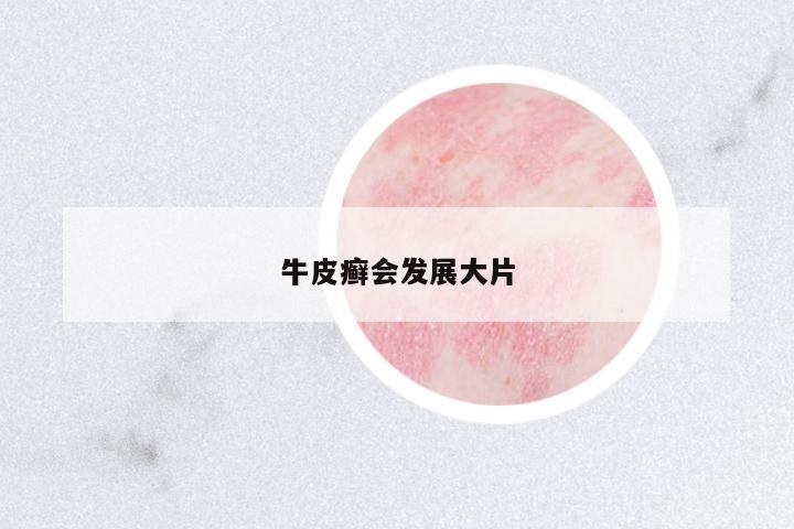 牛皮癬會發(fā)展大片