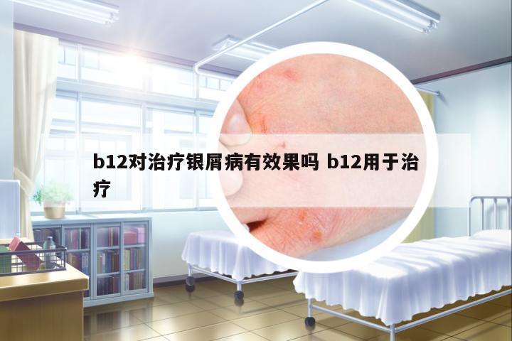b12對治療銀屑病有效果嗎 b12用于治療