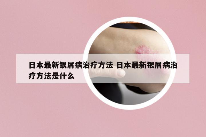 日本最新銀屑病治療方法 日本最新銀屑病治療方法是什么