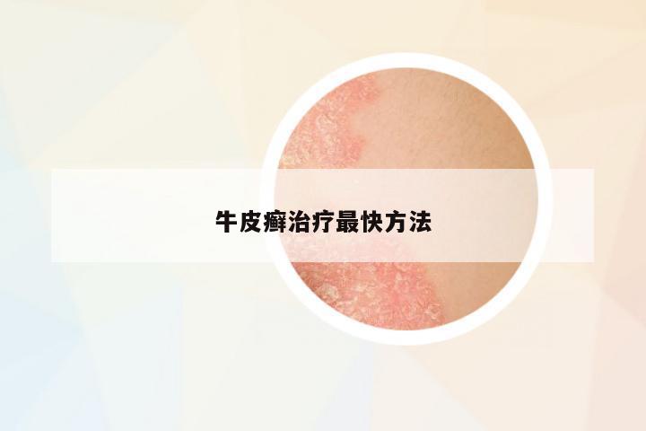 牛皮癬治療最快方法