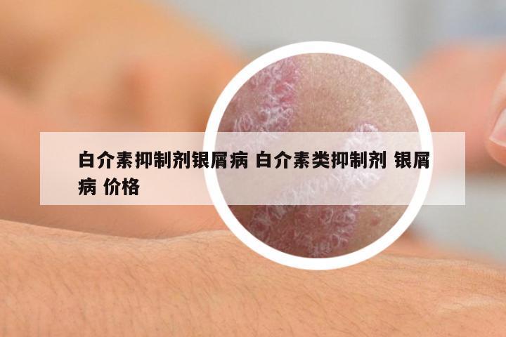 白介素抑制劑銀屑病 白介素類抑制劑 銀屑病 價格