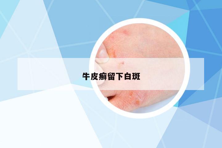 牛皮癬留下白斑