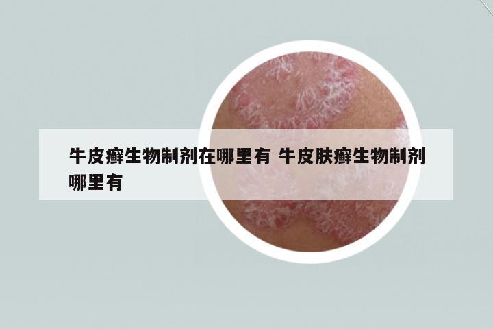 牛皮癬生物制劑在哪里有 牛皮膚癬生物制劑哪里有