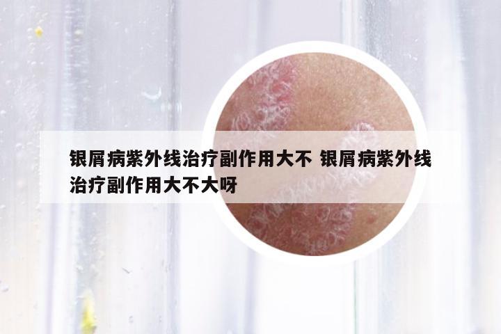 銀屑病紫外線治療副作用大不 銀屑病紫外線治療副作用大不大呀