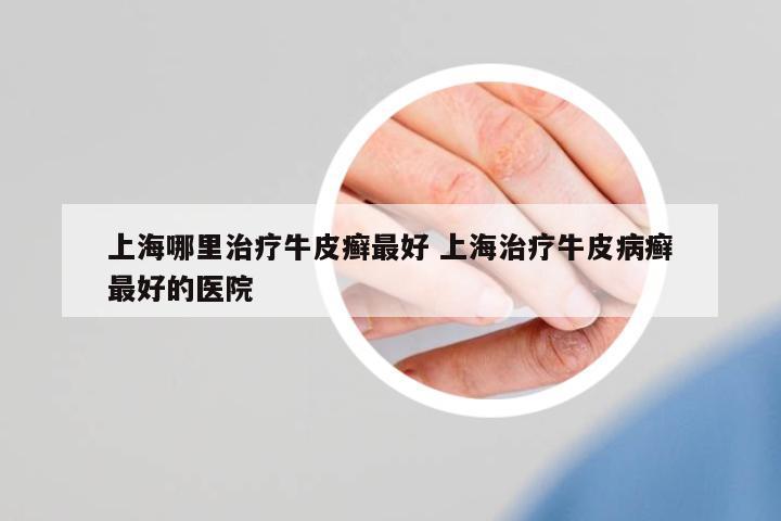 上海哪里治療牛皮癬最好 上海治療牛皮病癬最好的醫(yī)院