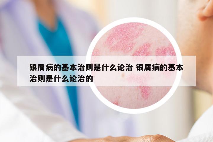 銀屑病的基本治則是什么論治 銀屑病的基本治則是什么論治的