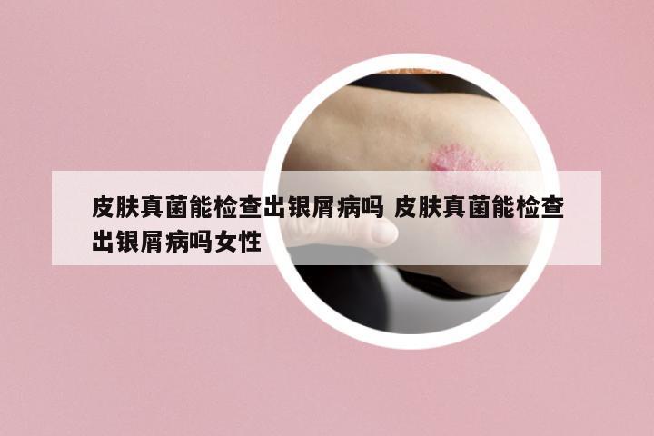 皮膚真菌能檢查出銀屑病嗎 皮膚真菌能檢查出銀屑病嗎女性