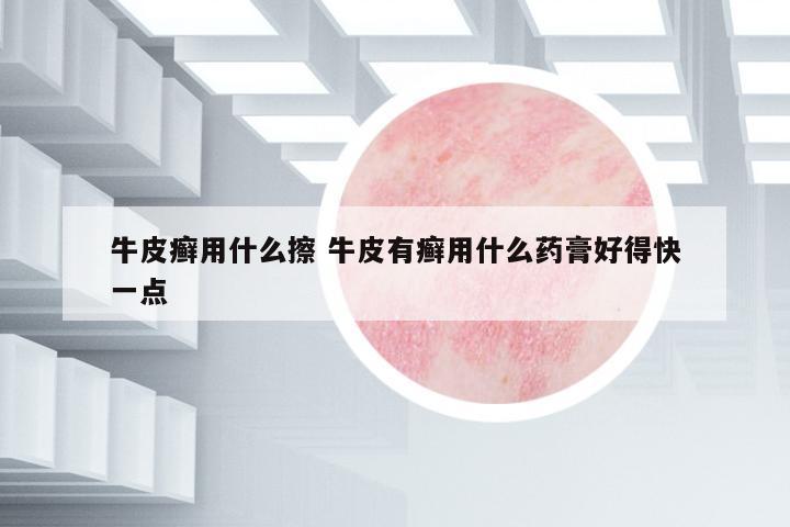 牛皮癬用什么擦 牛皮有癬用什么藥膏好得快一點(diǎn)