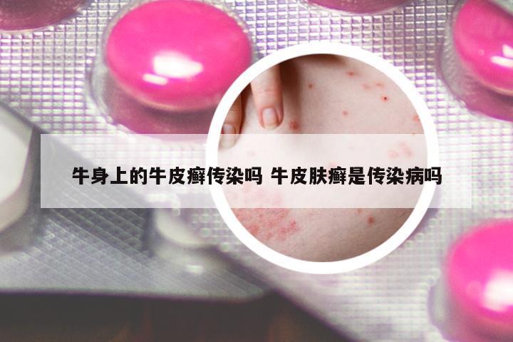 牛身上的牛皮癬傳染嗎 牛皮膚癬是傳染病嗎