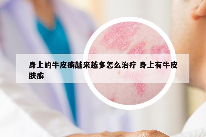 身上的牛皮癬越來越多怎么治療 身上有牛皮膚癬