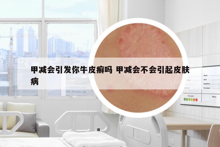 甲減會引發(fā)你牛皮癬嗎 甲減會不會引起皮膚病