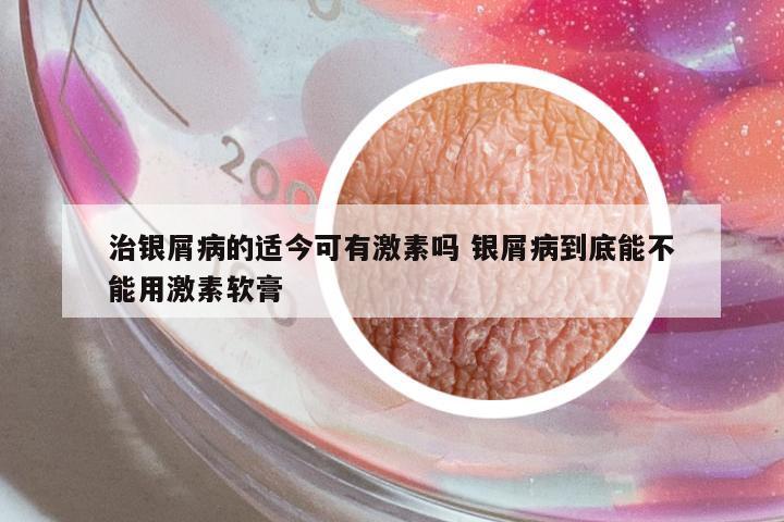 治銀屑病的適今可有激素嗎 銀屑病到底能不能用激素軟膏