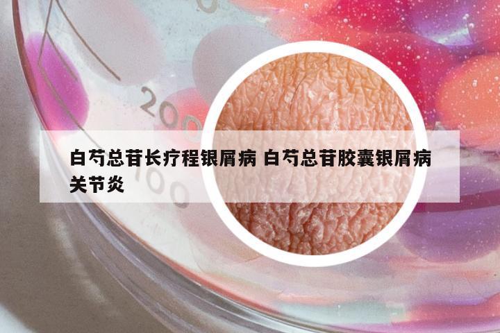 白芍總苷長療程銀屑病 白芍總苷膠囊銀屑病關(guān)節(jié)炎