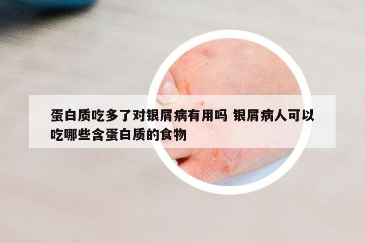蛋白質吃多了對銀屑病有用嗎 銀屑病人可以吃哪些含蛋白質的食物