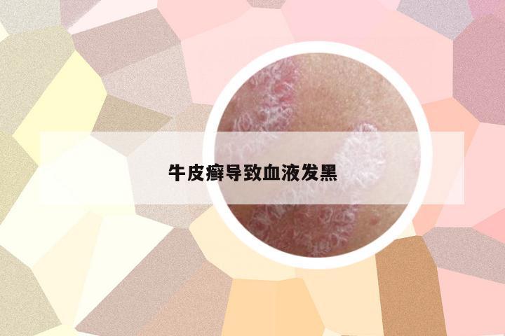 牛皮癬導(dǎo)致血液發(fā)黑