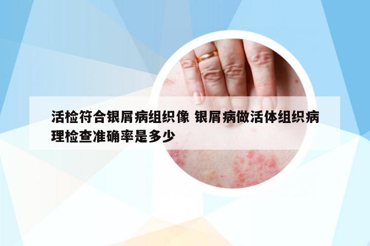 活檢符合銀屑病組織像 銀屑病做活體組織病理檢查準(zhǔn)確率是多少