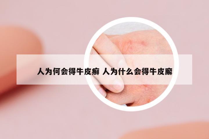 人為何會(huì)得牛皮癬 人為什么會(huì)得牛皮廨