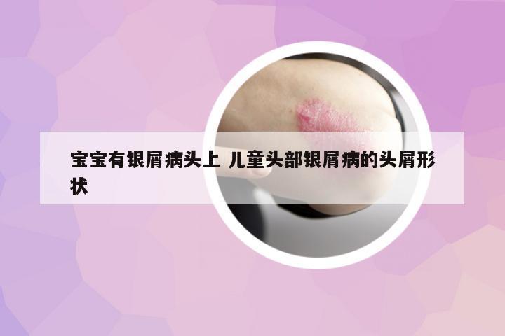 寶寶有銀屑病頭上 兒童頭部銀屑病的頭屑形狀