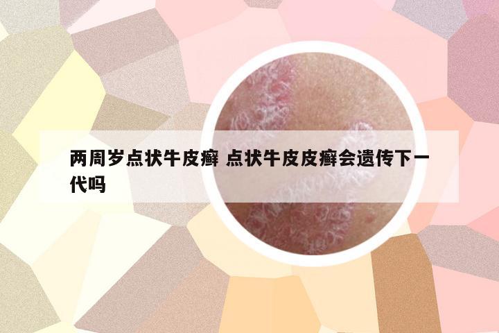 兩周歲點狀牛皮癬 點狀牛皮皮癬會遺傳下一代嗎
