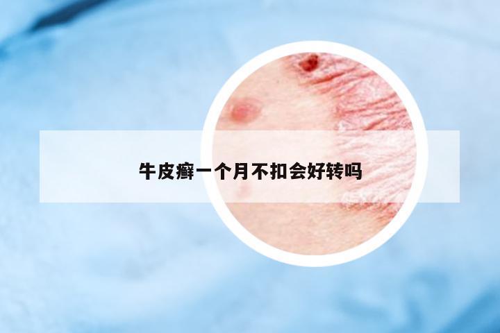 牛皮癬一個(gè)月不扣會(huì)好轉(zhuǎn)嗎
