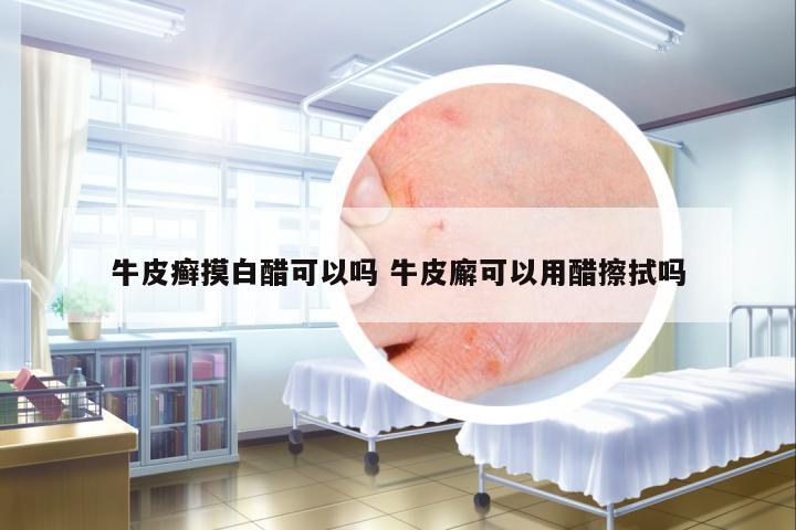 牛皮癬摸白醋可以嗎 牛皮廨可以用醋擦拭嗎