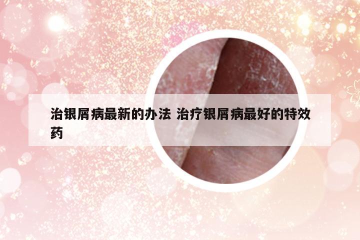 治銀屑病最新的辦法 治療銀屑病最好的特效藥