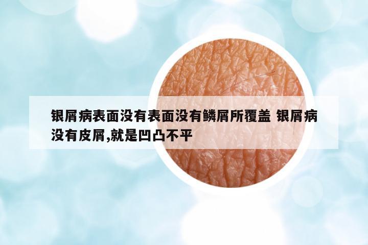 銀屑病表面沒有表面沒有鱗屑所覆蓋 銀屑病沒有皮屑,就是凹凸不平