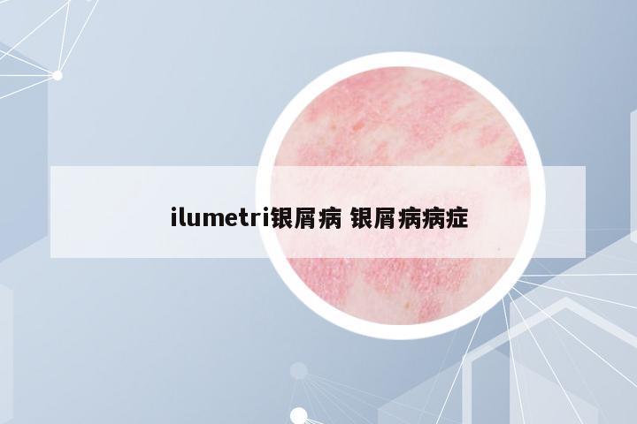 ilumetri銀屑病 銀屑病病癥