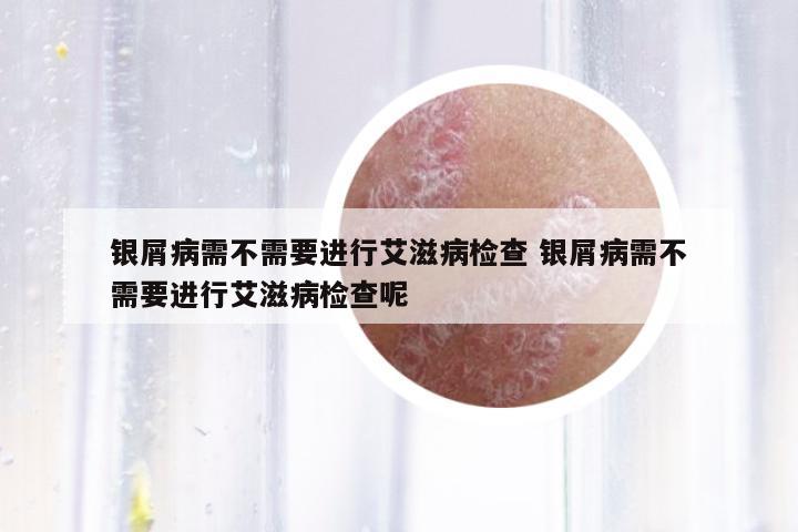 銀屑病需不需要進(jìn)行艾滋病檢查 銀屑病需不需要進(jìn)行艾滋病檢查呢
