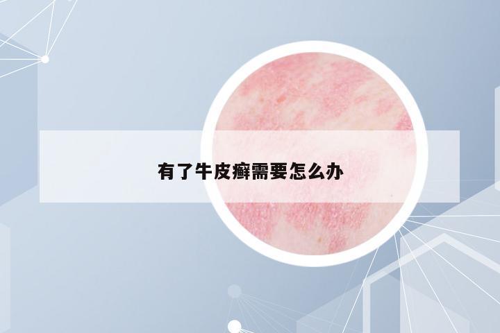 有了牛皮癬需要怎么辦