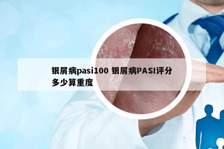 銀屑病pasi100 銀屑病PASI評(píng)分多少算重度