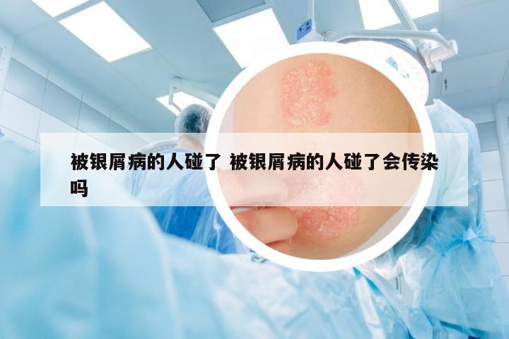 被銀屑病的人碰了 被銀屑病的人碰了會傳染嗎