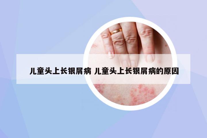兒童頭上長(zhǎng)銀屑病 兒童頭上長(zhǎng)銀屑病的原因