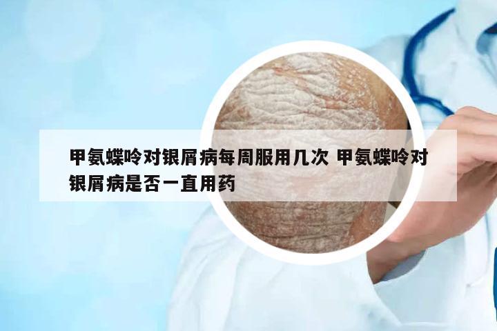 甲氨蝶呤對(duì)銀屑病每周服用幾次 甲氨蝶呤對(duì)銀屑病是否一直用藥