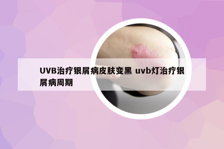 UVB治療銀屑病皮膚變黑 uvb燈治療銀屑病周期