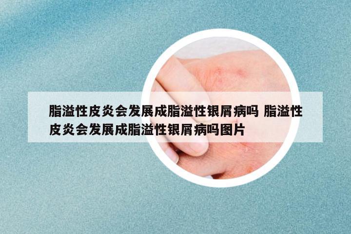 脂溢性皮炎會發(fā)展成脂溢性銀屑病嗎 脂溢性皮炎會發(fā)展成脂溢性銀屑病嗎圖片