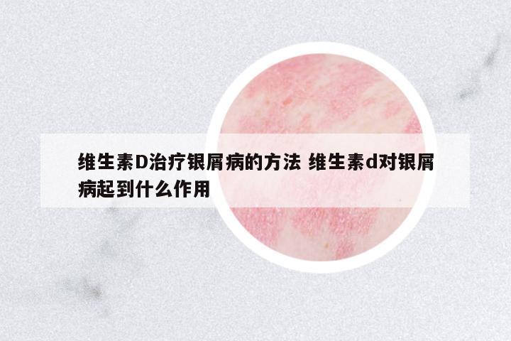 維生素D治療銀屑病的方法 維生素d對(duì)銀屑病起到什么作用