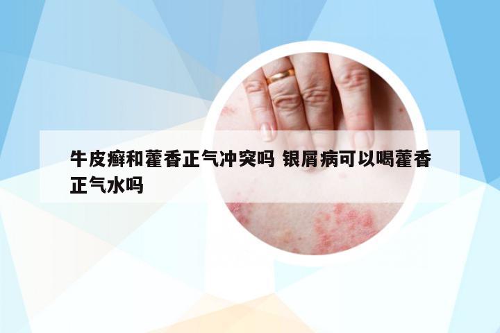 牛皮癬和藿香正氣沖突嗎 銀屑病可以喝藿香正氣水嗎