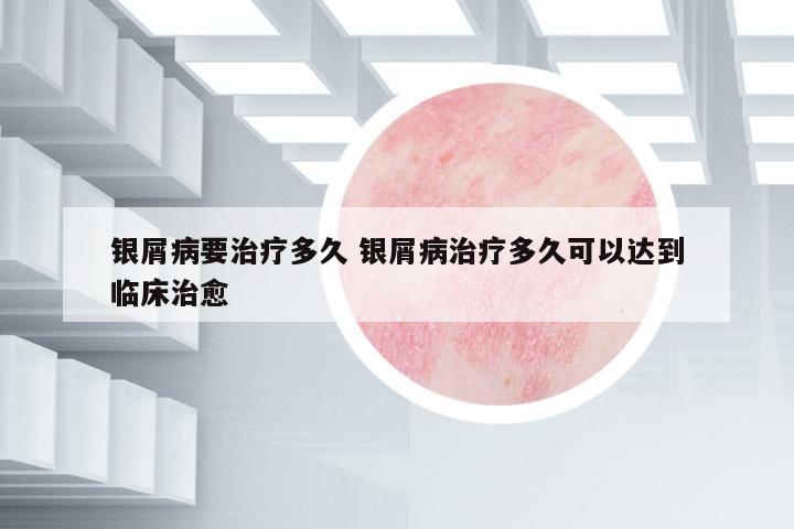 銀屑病要治療多久 銀屑病治療多久可以達(dá)到臨床治愈
