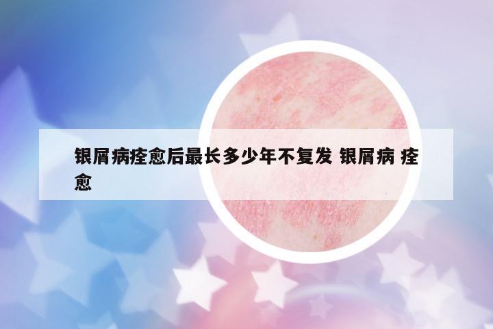 銀屑病痊愈后最長(zhǎng)多少年不復(fù)發(fā) 銀屑病 痊愈
