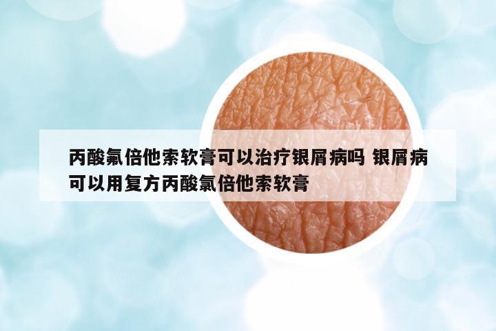 丙酸氟倍他索軟膏可以治療銀屑病嗎 銀屑病可以用復方丙酸氯倍他索軟膏