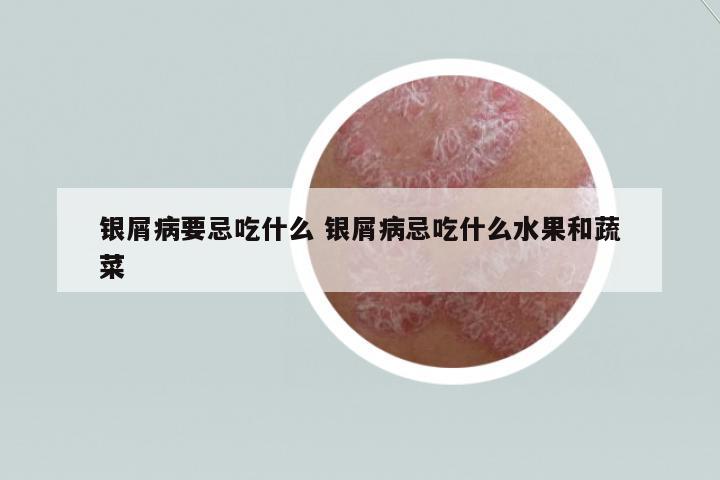 銀屑病要忌吃什么 銀屑病忌吃什么水果和蔬菜
