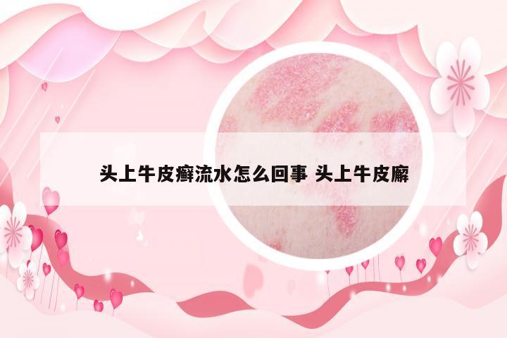 頭上牛皮癬流水怎么回事 頭上牛皮廨